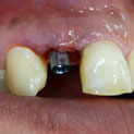Ausencias de un solo diente