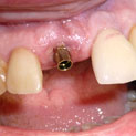 Ausencias de un solo diente